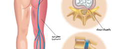 what is sciatic nerve pain 03 7ekkqr03s18suwwk9sb7pn7mmr1i4md816