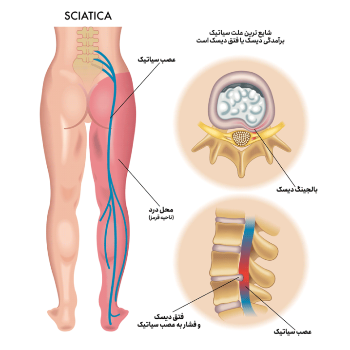 what is sciatic nerve pain 03